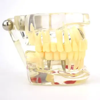 ПВХ, прозрачные патологические зубы, модель полости рта, медицинские обучающие модели